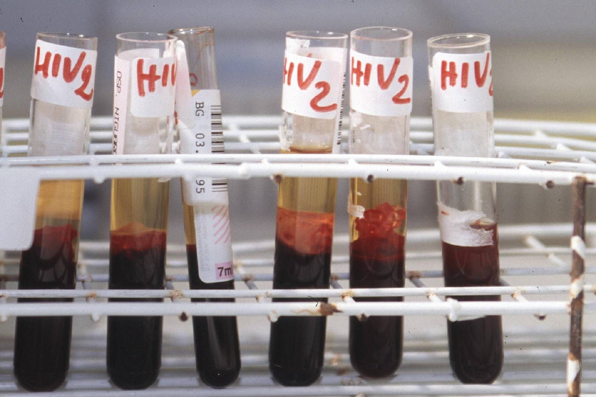 otto-persone-su-10-con-hiv-sviluppano-disturbi-di-salute-mentale-al-via-campagna