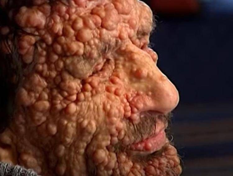 Neurofibromatosi, il morbo che deturpa il volto: ecco la malattia che ha commosso il Papa Neurofibromatosi, il morbo che deturpa il volto: ecco la malattia che ha commosso il Papa