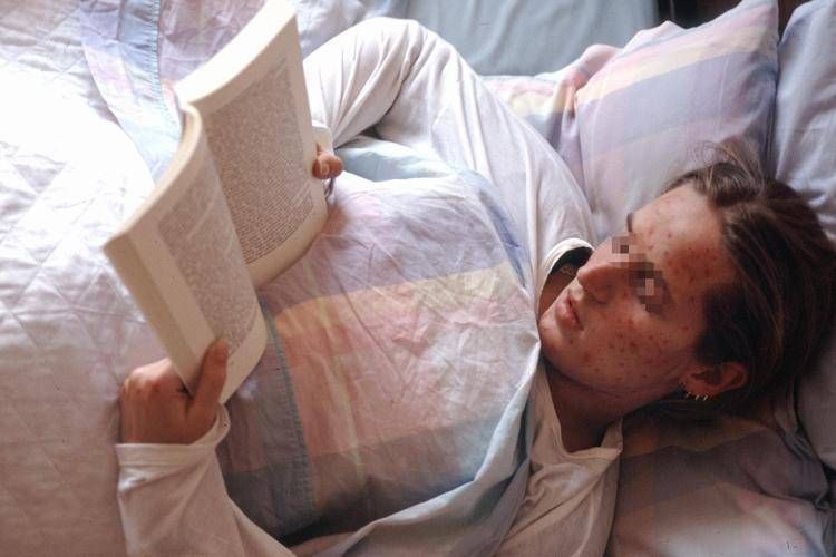 RAGAZZA AMMALATA A LETTO CON IL MORBILLO LEGGE UN LIBRO  - FOTOGRAMMA