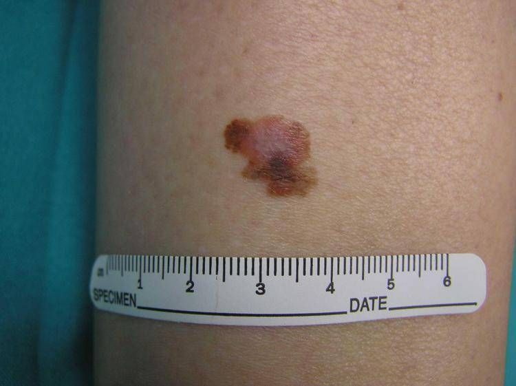 Un melanoma