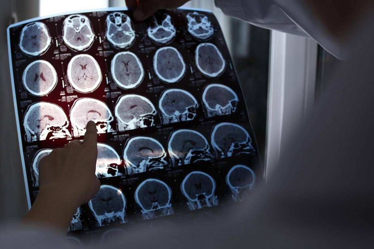 L'Alzheimer si eredita? Più rischi se lo ha avuto la mamma: lo studio
