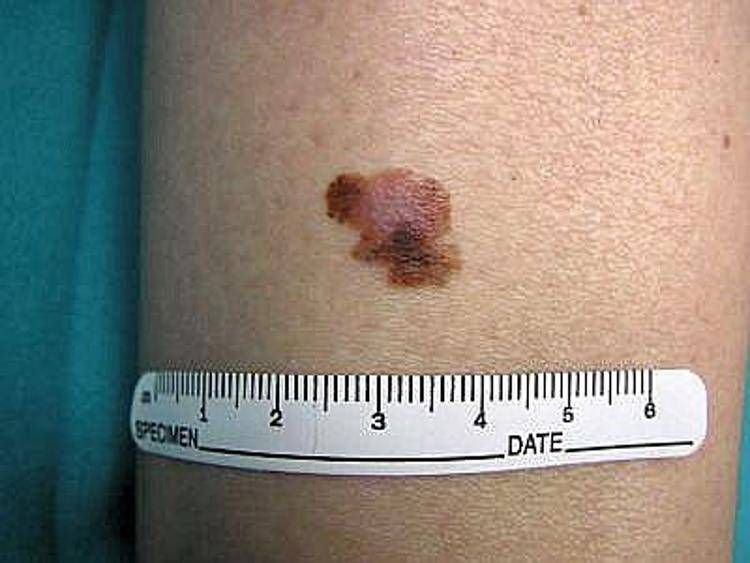 melanoma boom melanoma boom