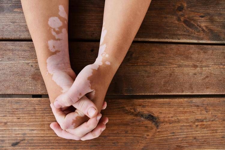 Salute, dermatologo Paro Vidolin: 