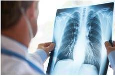 Curare il cancro al polmone senza chirurgia, prima italiana all'Ieo di Milano