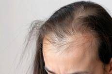 https://www.adnkronos.com/resources/0293-1c5f6f4b2ee8-33e2f364e611-1000/format/medium/alopecia-free.jpeg