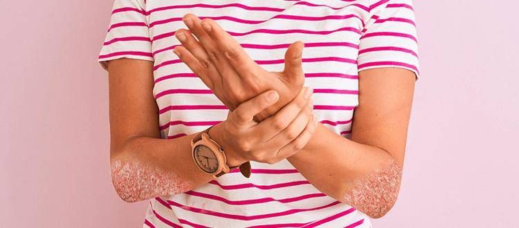 In Italia 1,5 mln con psoriasi, al via campagna digitale 'Psorridi'