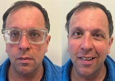 Lenti ICL, una soluzione efficace anche per miopie moderate