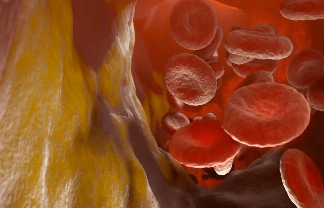 İtalyan çalışması, RNA tedavisi LDL kolesterolü %60'ın üzerinde azaltıyor