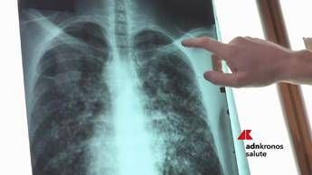 Malattie rare: ipertensione arteriosa polmonare, l’home delivery porta la terapia a casa. Speciale Salus TV.