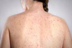 Morbillo, la verità sulla vitamina A: 