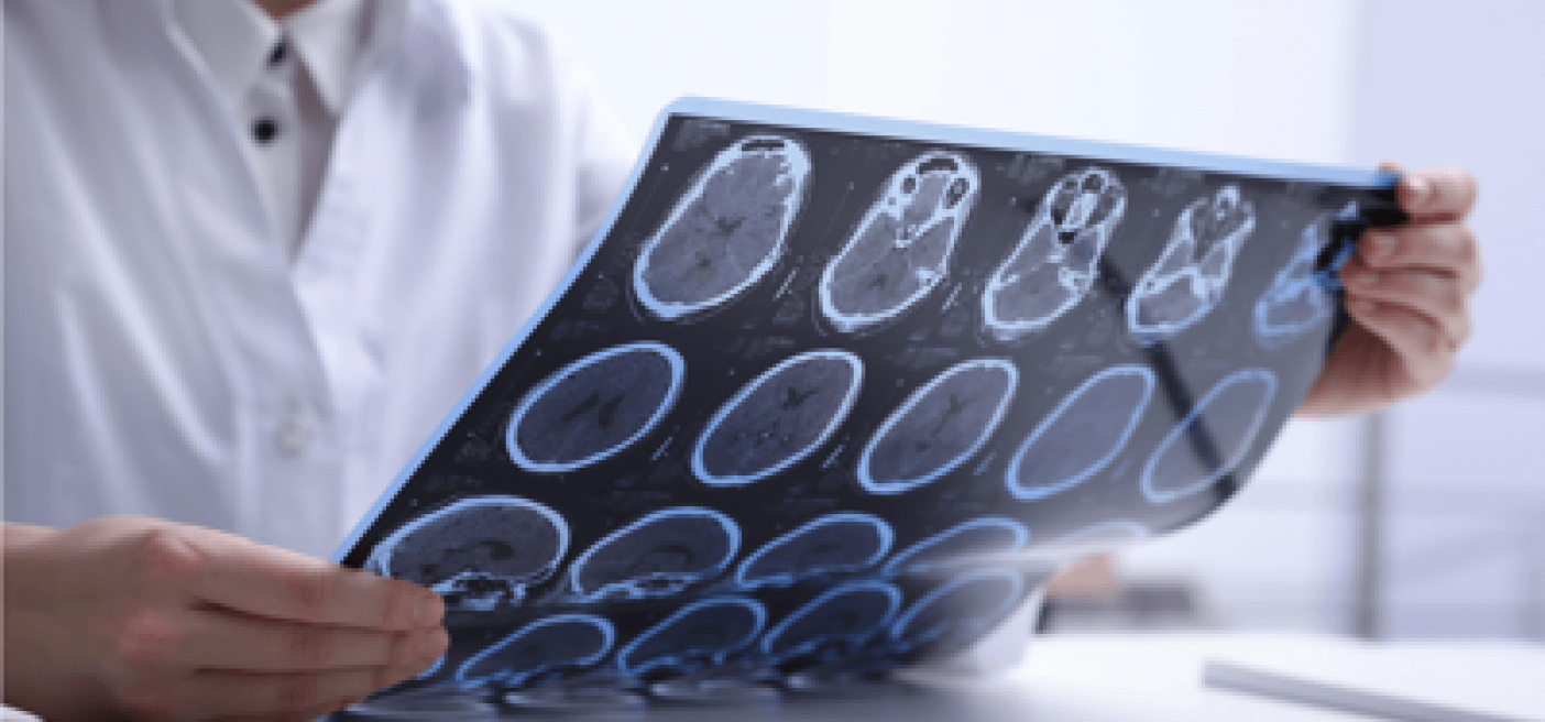 Sclérose en plaques : 10% des patients italiens sans suivi