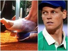 La vescica di Jannik Sinner