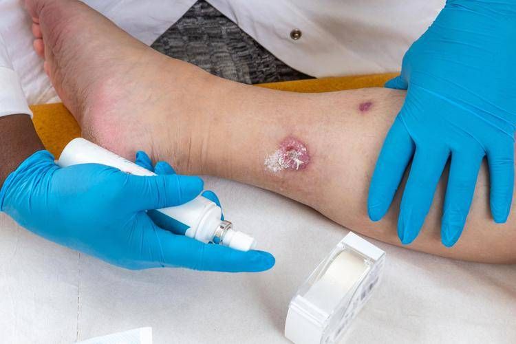 Idrosadenite suppurativa, quando fare la doccia o dormire diventano ostacoli