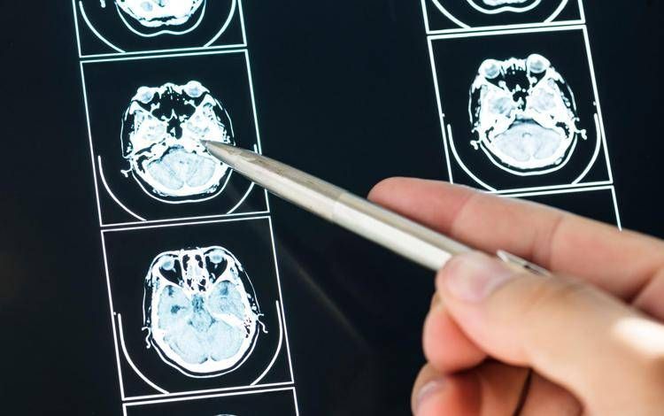 Intelligenza Artificiale può prevedere evoluzione Parkinson, lo studio italiano