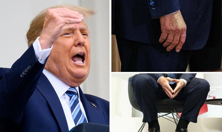 Trump e le gambe gonfie, cos'è l'insufficienza venosa cronica