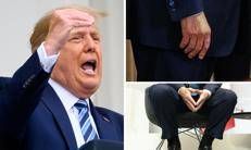 Trump e le gambe gonfie, cos'è l'insufficienza venosa cronica