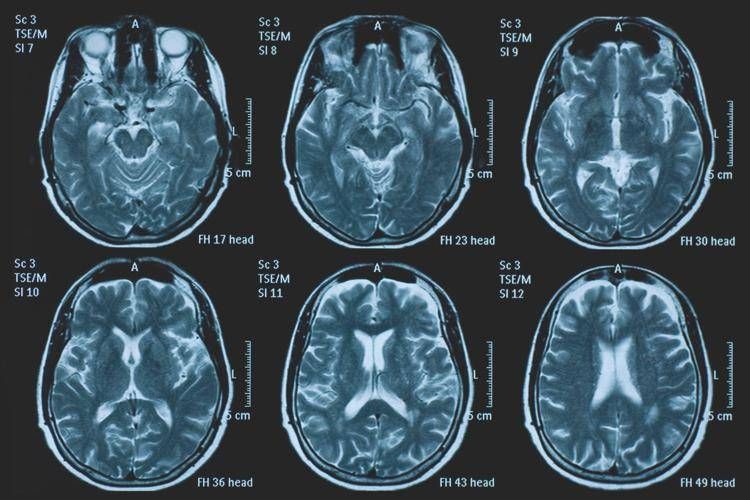 Tumori, glioma pediatrico di basso grado: via libera in Europa a prima terapia mirata