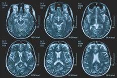 Tumori, glioma pediatrico di basso grado: via libera in Europa a prima terapia mirata