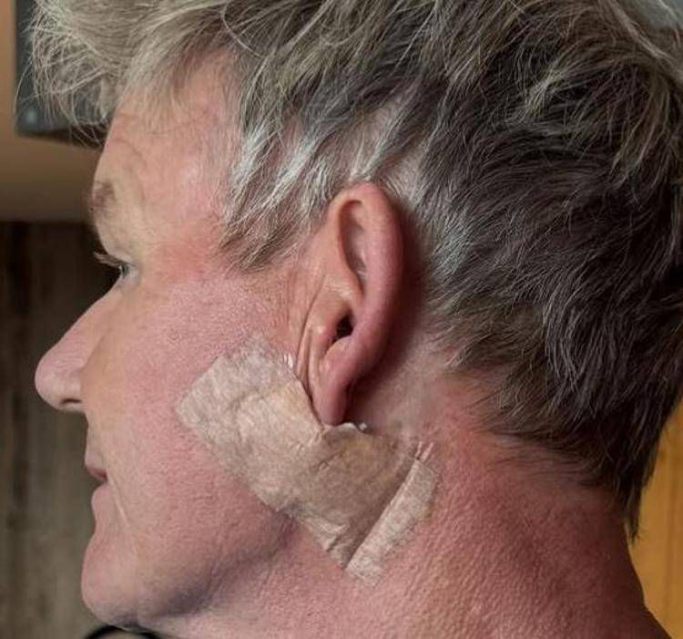 Gordon Ramsay: "Operato per tumore della pelle"