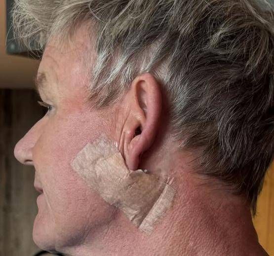 ゴードン・ラムゼイと革の癌の手術：「それは持ち上げではありません…」