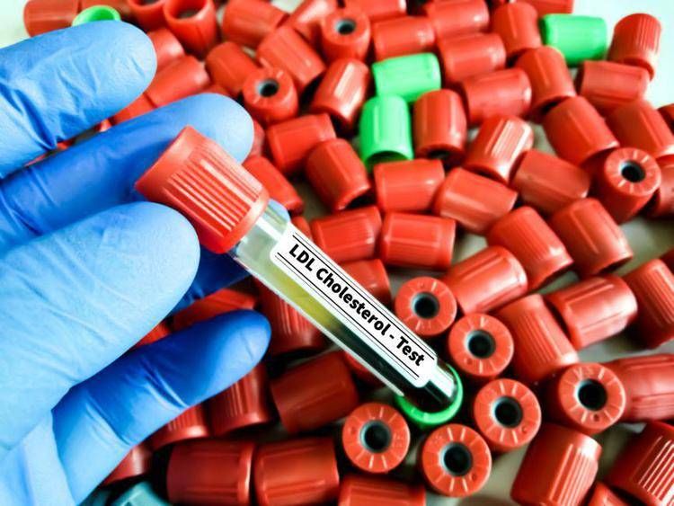 Colesterolo Ldl, per abbassalo in sviluppo nuova terapia con tripla combinazione 