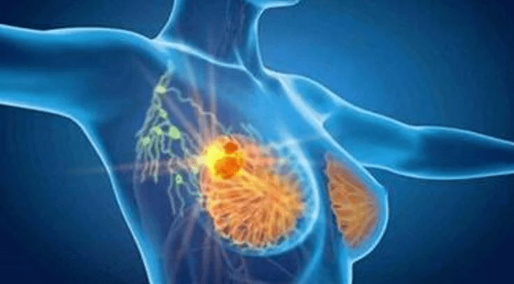Cancro seno, con profilazione molecolare e terapie target migliori prospettive di cura