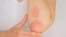 Giornata della psoriasi, Ucb conferma il suo impegno a fianco dei pazienti