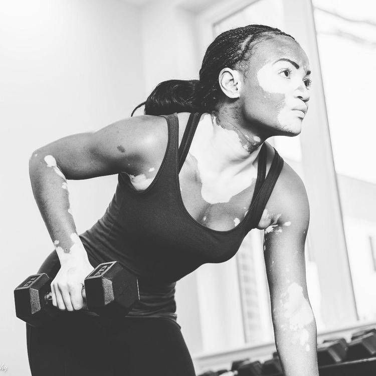 Tiffany Taylor, ragazza con vitiligine che vuole seguire le orme della supermodel e attivista Winnie Harlow - (Fotogramma/Ipa)