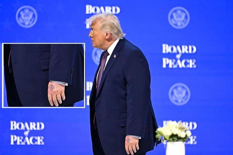 Donald Trump, nuovo grande livido sul dorso della mano sinistra - (Afp)
