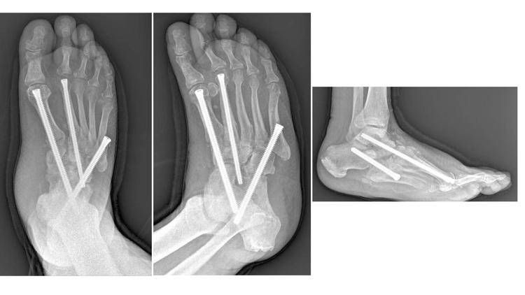 la neuro-osteoartropatia di Charcot - Gemelli