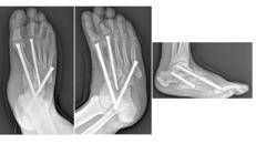 la neuro-osteoartropatia di Charcot - Gemelli