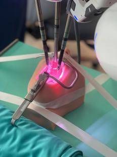 Intervento pionieristico al Meyer, rimossa una cisti sublinguale con il robot