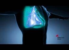 Bronchiectasie, esperti a Milano su malattia cronica diffusa ma spesso trascurata