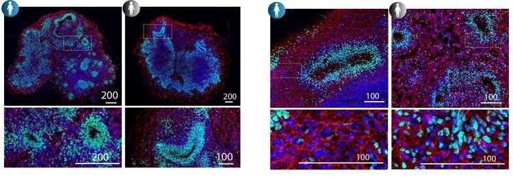 Studio italiano, 'la Sma colpisce dall'embrione, cruciali screening e cure precoci'