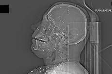 Pallini nella radiografia cranica di un paziente  - The Guardian