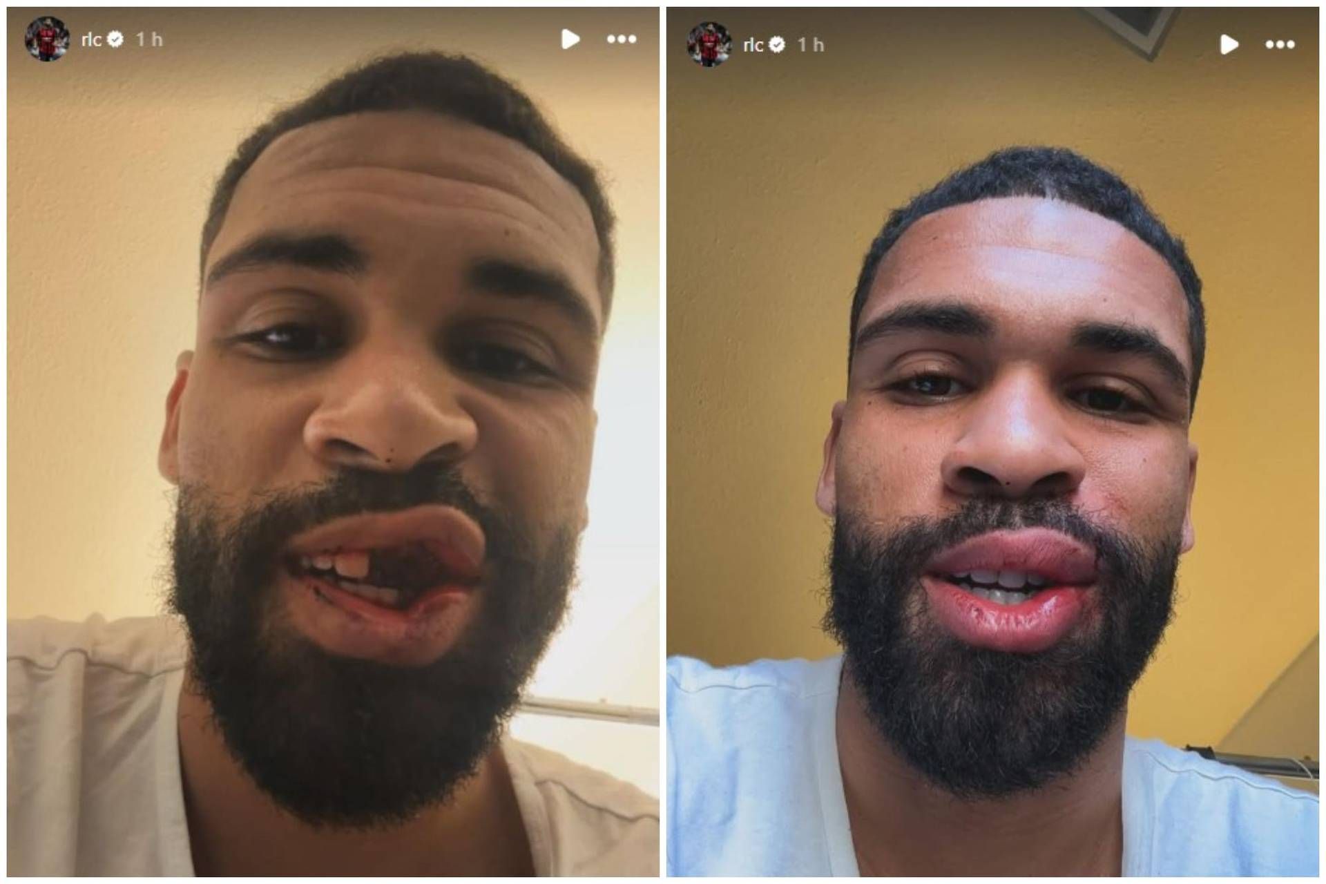 Loftus-Cheek, foto choc dopo scontro in Milan-Parma. Quando torna in campo? Loftus-Cheek, foto choc dopo scontro in Milan-Parma. Quando torna in campo?