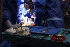 Malattia cronica da trapianto contro l'ospite, via libera Ue a belumosudil ﻿