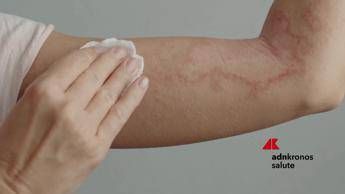 Psoriasi per 1,5 mln italiani, oltre 750 visite gratuite nell'Open day nazionale