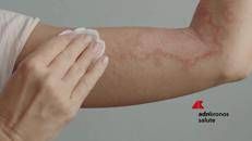 Psoriasi per 1,5 mln italiani, oltre 750 visite gratuite nell'Open day nazionale