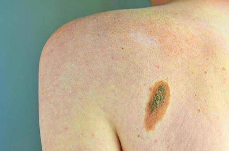 Ogni anno in Italia 2.600 casi ereditari di melanoma, Imi: