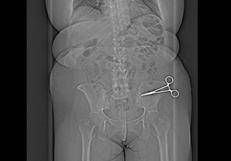 La radiografia che mostra le forbici all'interno del corpo della paziente