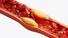 Salute: nuove linee guida dislipidemie, 'abbassare e stabilizzare colesterolo'