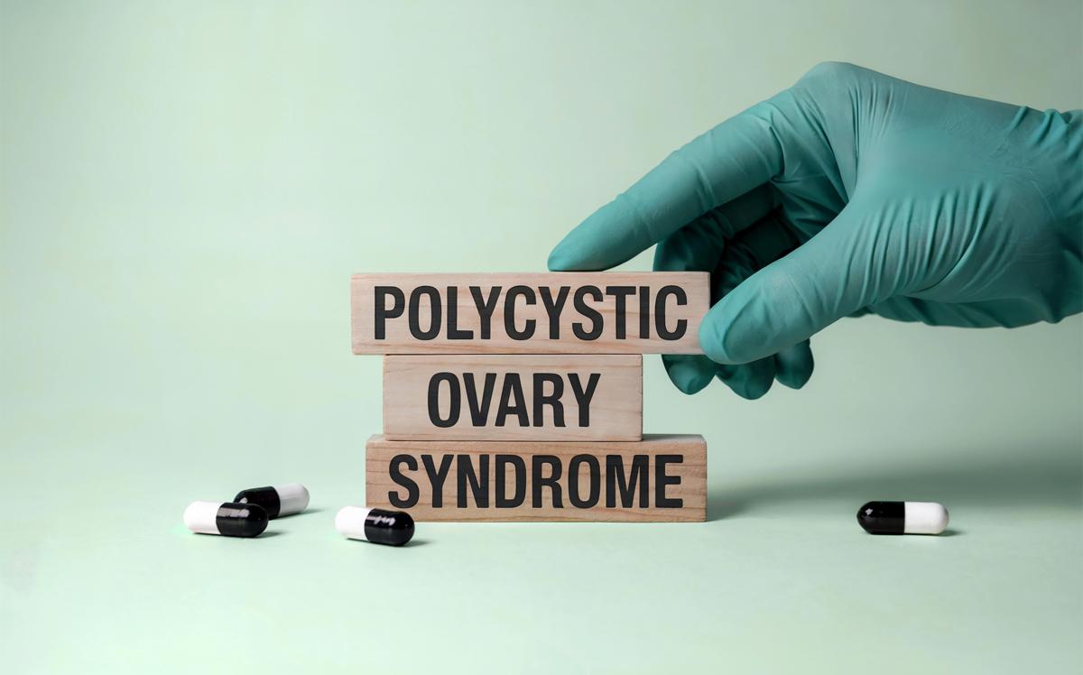 Sindrome ovaio policistico cambia nome, sarà indicato con la sigla Pmos