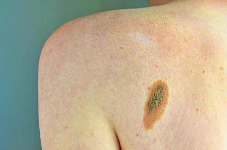 Melanoma - Foto Adobe
