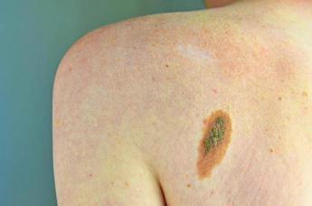 Melanoma, Adoi: "Bene nuova legge su prevenzione, dermatologo centrale in screening"