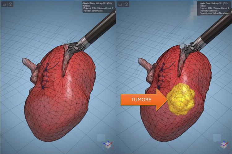 Modelli tridimensionali biomimetici del cancro al rene di un paziente per chirurgia robotica sempre più precisa