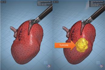 Modelli tridimensionali biomimetici del cancro al rene di un paziente per chirurgia robotica sempre più precisa
