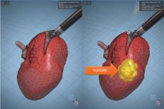 Modelli tridimensionali biomimetici del cancro al rene di un paziente per chirurgia robotica sempre più precisa