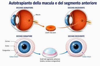 Torna a vedere dopo trapianto di retina da un occhio all'altro, è la prima volta al mondo