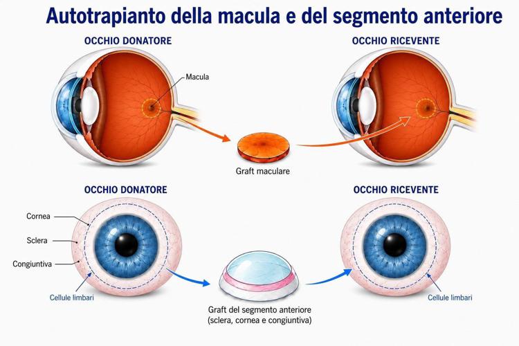 Lo schema del trapianto